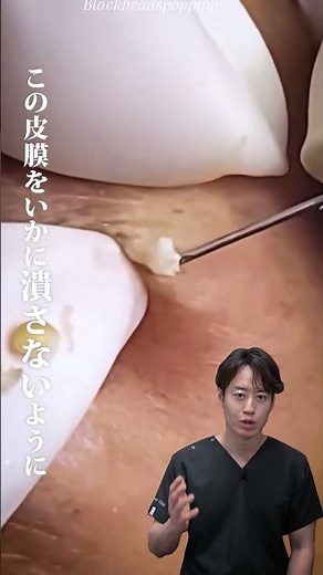 [Viewer discretion advised] Treatment for sebaceous cysts