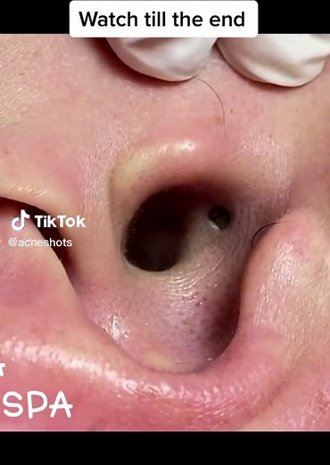 Effective Ways to Remove Blackhead Inside Ear