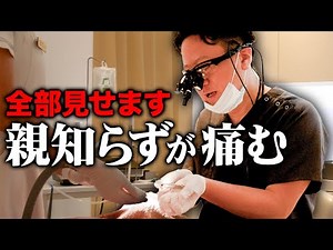 親知らずの抜歯！横向きに生えて痛む親知らずの治療シーンをノーカットでお届け！【審美歯科 抜歯治療】