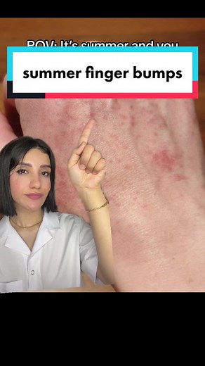 Managing Eczema in Different Seasons: Tips and Tricks