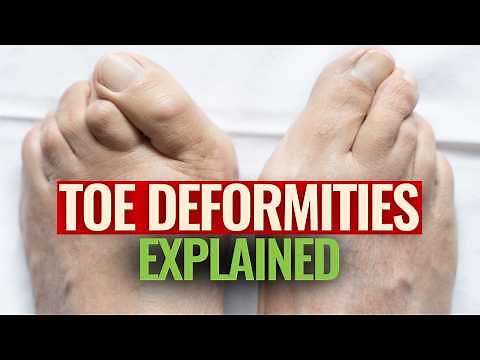 Understanding Toe Deformities: A Natural Approach By Podiatrist