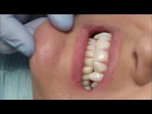 Professionally made Vampire Fangs