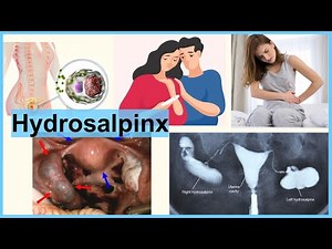 hydrosalpinx