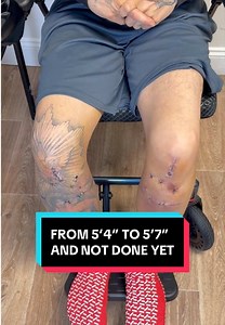 A decision he feels confident about 🦴🩺 #heightlengthening #limblengthening #patientjourney #confidenceboost #gettaller