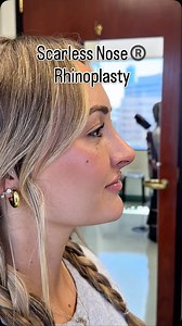 Subtle Finesse Rhinoplasty. 120 years of Scarless Rhinoplasty excellence passed down from mentor to mentee with my own pioneered technique of Scarless Nose®️ which combines the artistic approach of scarless rhinoplasty most advanced technology most natural sophisticated demure results. We have it down to a science. But then we elevated it to an art. An art that transcends the basic cookie-cutter nosejob. This is for the discerning clientele looking for the most discreet, subtle, finesse refineme
