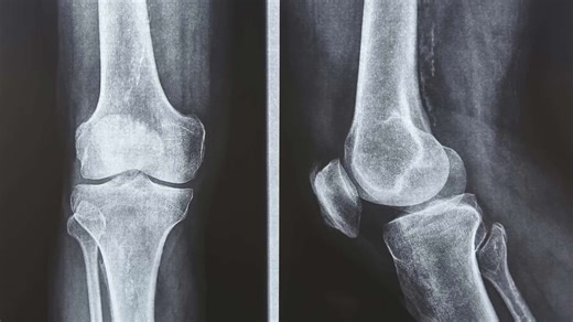 Knee x-rays 101. How to interpret your x-ray report