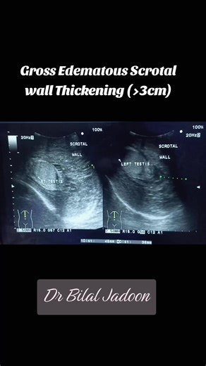 Understanding Bilateral Edematous Scrotal Wall Thickening