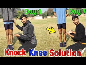 Knock knee कैसे ठीक करें | Knock knee problem solution | knock knees best exercise and tips in hindi