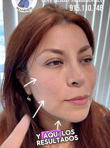 Rejuvenecimiento Facial Sin Cirugía en Solo 30 Minutos
