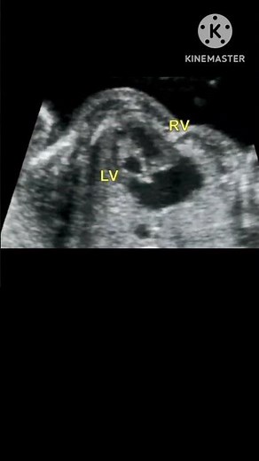 Hypoplastic left heart syndrome #ultrasound #pregnancyscan #radiology #pregnant