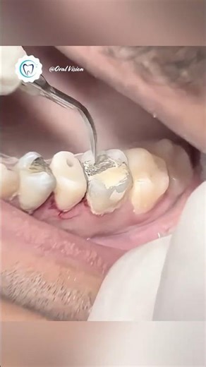 Real Teeth Cleaning 🦷 | Step-by-Step Plaque Removal #Shorts