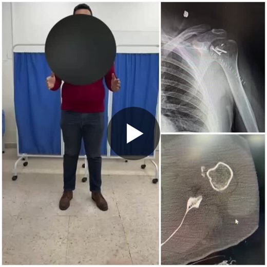 #orthopedics #shouldersurgery #sportsmedicine #patientoutcomes #rehabilitation #casestudy | Omar Ikhmayyes