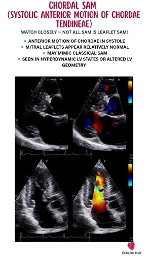 CHORDAL SAM (Systolic Anterior Motion of Chordae Tendineae) #ChordalSAM #LVOTObstruction