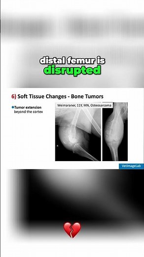 Osteosarcoma: Key Features in Soft Tissue #shorts