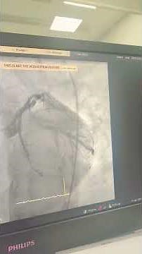 Coronary Angiography Views Explained by Prof Dr Vivek Gupta Senior Cardiologist Apollo hosp 19.4.26