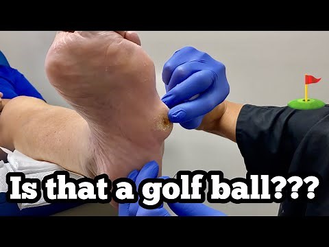 DEBRIDEMENT OF A HUGE BALL FROM THE FOOT