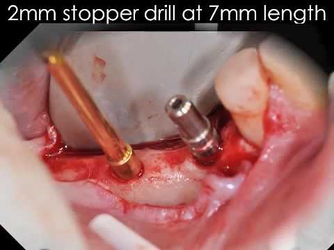 MegaGen Implants AnyRidge Surgical Protocol Video