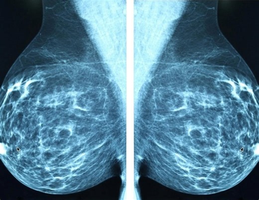 Revolutionizing Triple-Negative Breast Cancer Treatment: The Future of Immunotherapy Unveiled – Archyde