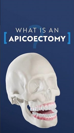 What is an Apicoectomy?