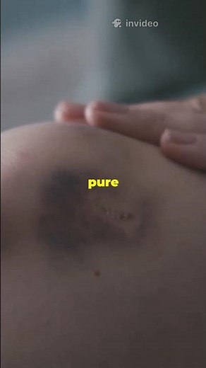 Why Do Bruises Change Color? The Science of Healing Stages