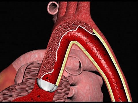 Aortic Dissection and Cardiac Tamponade