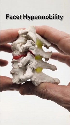 Cervical Instability Model by Dynamic Disc Designs