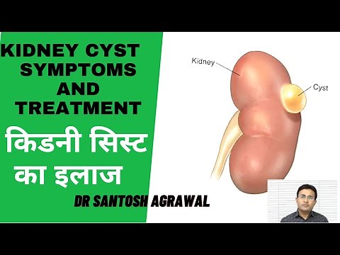 Kidney Cyst Treatment I Renal Cyst I Kidney Ki Gathan