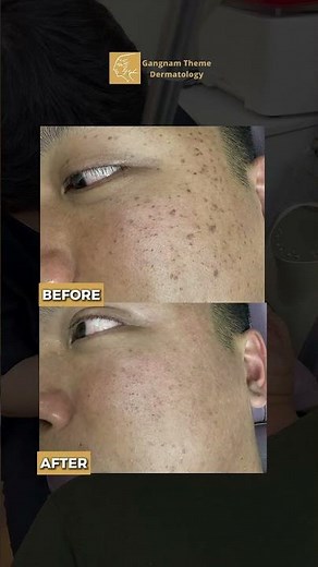 CO2 Mole Removal: 1-Day Glow-Up, Zero Worries ✨