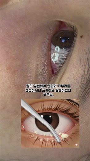 #구미여드름 구미여드름 멀리 김천에서 안과,피부과를 가셔도 해결이 안 되셔서 저희 아라에스테틱을 찾아주신 고객님. 마이봄샘(눈꺼풀 기름샘) 피지 고민으로 찾아주셨습니다. 철저한 위생과 후 처치로!깔끔히 완료! ✅️아라에스테틱프로그램✅️ 지루여드름 극과민성&피부장벽트러블 모공&트러블 속건조&극건조트러블 피부근원회복관리 주사비&혈관성트러블 피부볼륨&콜라겐생성 PDRN 엑소좀 인동본점(ara_aestetic_main) 광주점(ara_aestetic_gwangju) 상모점(ara_aestetic_sangmo) 아산점(ara_aestetic_asan) 산동점(ara_aestetic_sandong)