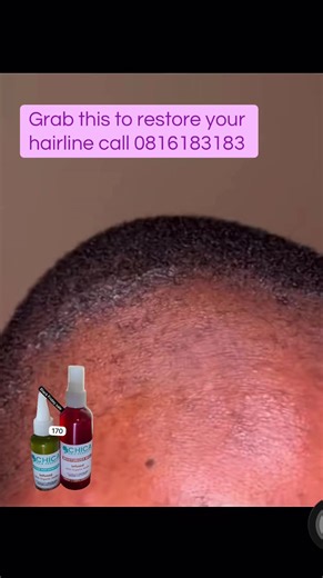Restore Your Hairline with Top Hair Products