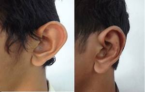 Plastic Ear Surgery In India: Results, Recovery And Cost – Richardson's Plastic Surgery Hospitals