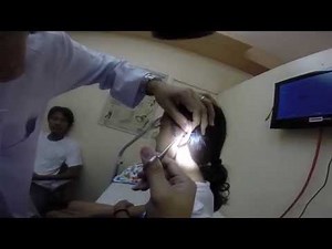 Cockroach Removal from child's ear