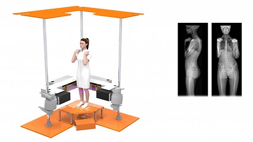 The EOS X-ray imaging system is the first technology that provides images of a child in their natural standing or seated position, allowing doctors to see how their joints and bones naturally interact. This system uses an ultra-low radiation dose, 60%-90% less than a traditional x-ray, particularly beneficial to children who get imaged often. Imaging takes just 20 seconds, so the child doesn’t have to hold still as long, and it requires less time spent changing positions which leads to more comf
