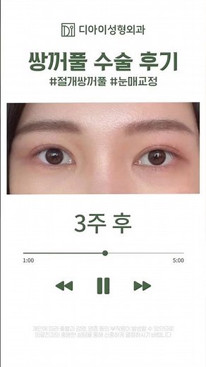 절개 쌍수 6개월, 부기 빠지는 과정 리얼하게 보여드림 (수술 전~6개월) | 디아이성형외과
