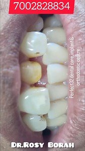 Broken front teeth//drrosyborah//drrosyborah//shorts//viral #viralshorts | DrRosy Borah