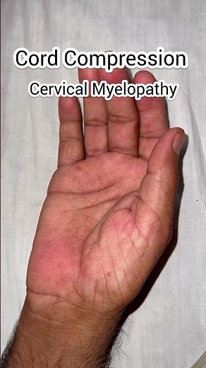 Thenar and Hypothenar Atrophy due to Cervical Cord Compression l #cervicalmyelopathy #thenaratrophy