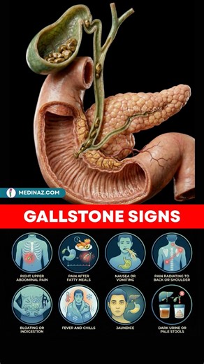 Signs and Symptoms of Gallbladder Stones Right Upper Abdominal Pain → Sudden pain in the upper right side of the abdomen → Pain may be sharp, cramping, or intense → Often occurs when a stone blocks bile flow → Pain can last from minutes to hours Pain After Fatty Meals → Pain starts 30–60 minutes after eating → Triggered by fried or oily food → Happens because the gallbladder contracts to release bile Nausea or Vomiting → Feeling sick after meals → Recurrent vomiting episodes → Due to impaired di