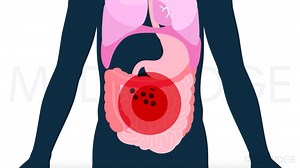 Hypermobile Ehlers-Danlos Syndrome and Hypermobility Spectrum Disorders | Medbridge