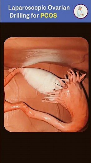 Laparoscopic ovarian drilling.