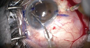 Adjustable Flange Technique for Scleral Fixation of a Single-Piece IOL - Eyetube