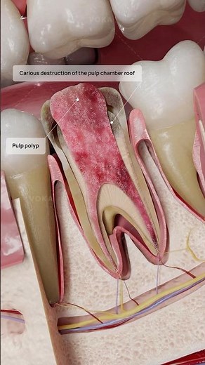 Pulp hyperplasia explained: a 3D visualization of irreversible pulpitis