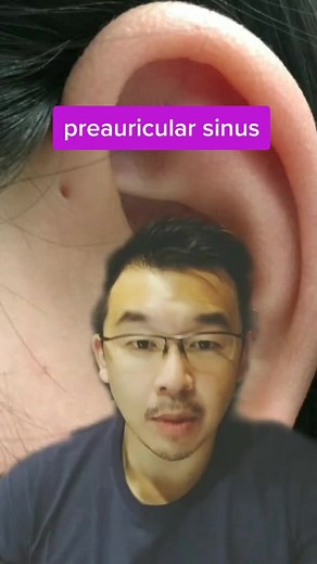 Understanding the Preauricular Sinus: Causes, Symptoms, and Treatment