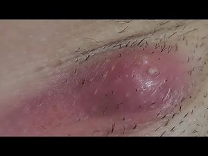 how to remove a BOIL every single time