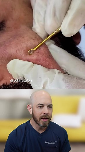 Huge Blackhead Extraction Close-Up: Giant Blackhead Removal