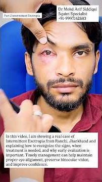Eye Looks Normal Sometimes, Squint Sometimes? | Intermittent Exotropia Case | Dr MA Siddiqui #squint