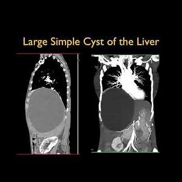 Large Simple Cyst of the Liver #ctscan