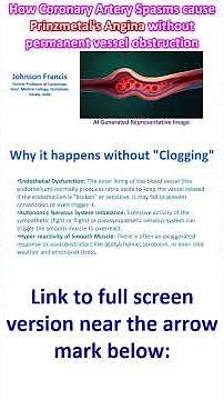 How Coronary Artery Spasms cause Prinzmetal Angina without permanent vessel obstruction