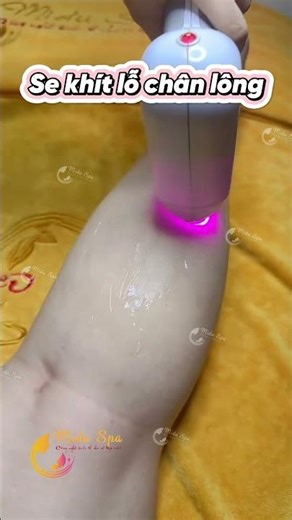 Triệt lông chân vĩnh viễn bằng laser diode - không đau – Da mịn như lụa