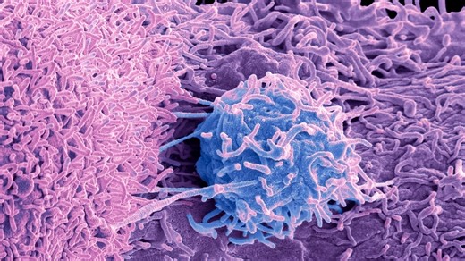 Researchers find new prostate cancer biomarkers to help improve diagnosis and treatment