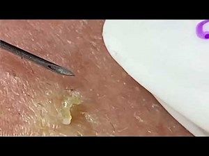Relax & Unwind: Gentle Acne Treatment (ASMR) #10 | Loan Spa
